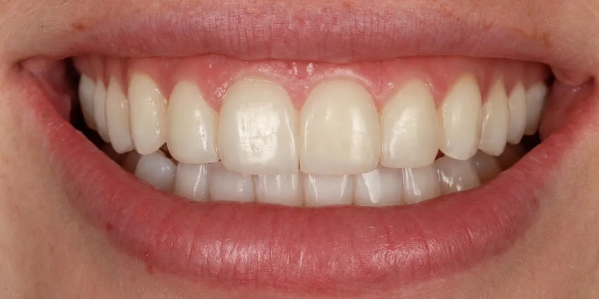 After: Edge bonding after Invisalign treatment
