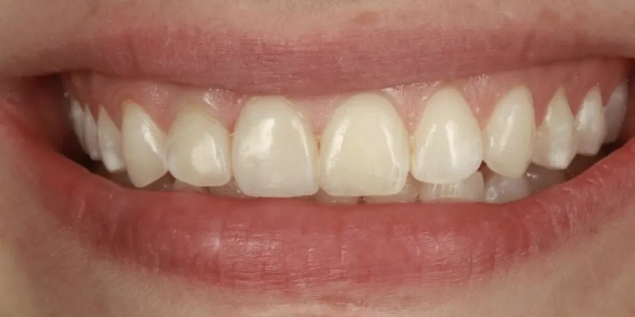 After: Camouflaging dark teeth