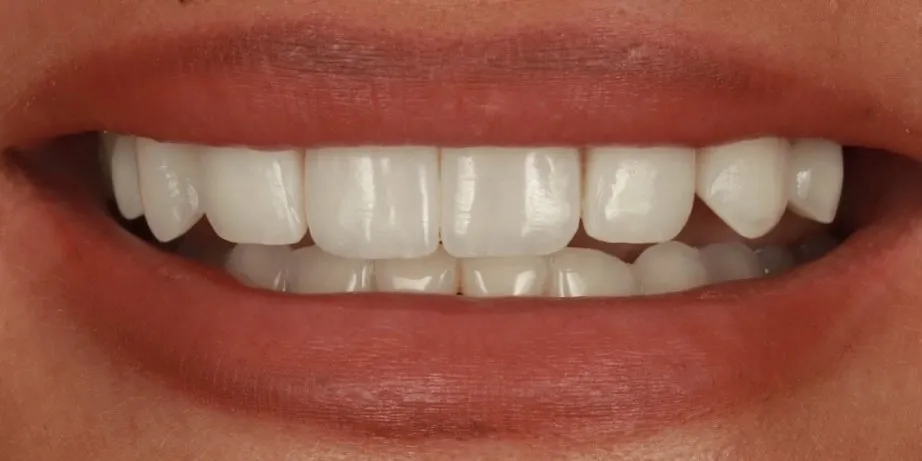 After: Putting right composite veneers that looked unnatural and were failing