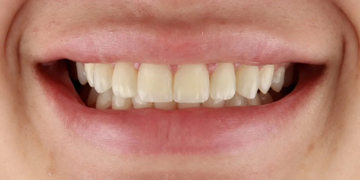 After: Bonding on the front teeth to rebalance proportions, close spaces and hide white and dark marks