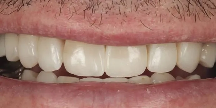 After: Composite veneers suited to the patient's age, within a full-mouth rehabilitation
