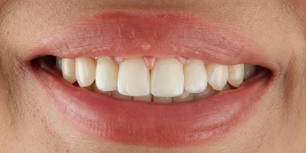 After: Invisalign for a front-tooth gap
