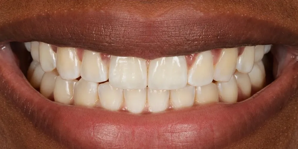 After: Invisalign for a second front gap