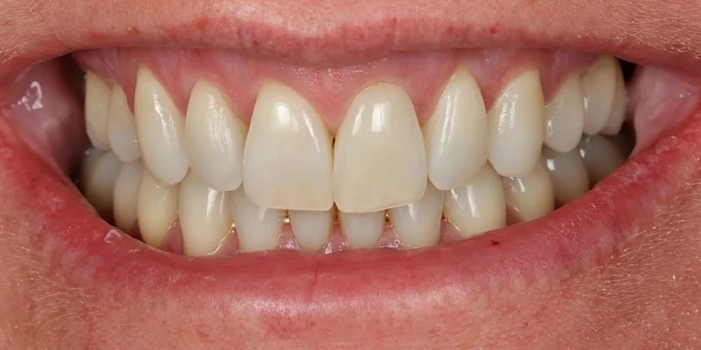 After: Invisalign for crowded, backward-tipped front teeth