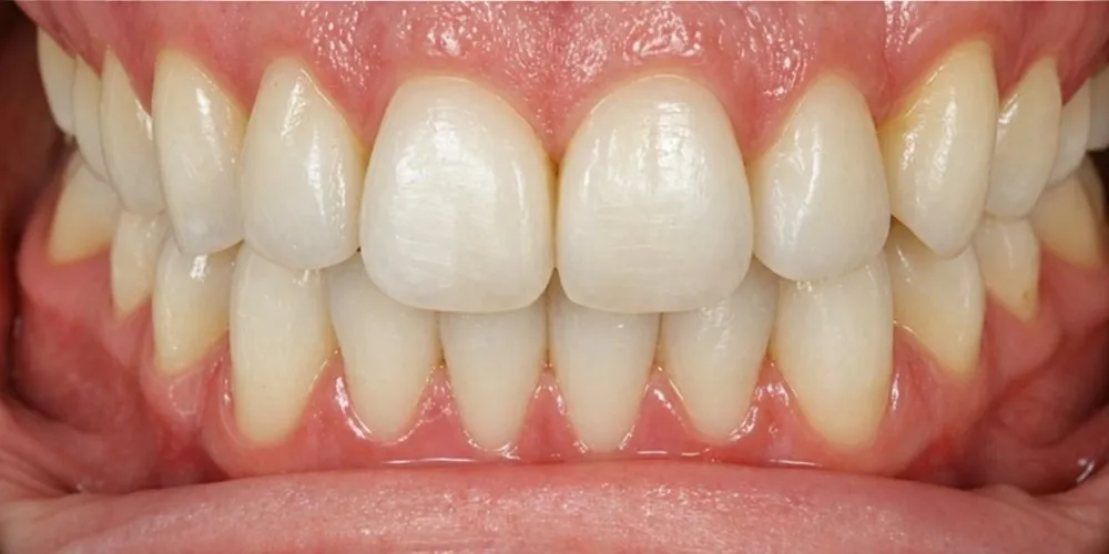 After: Invisalign for an open bite and crossbites, front and back