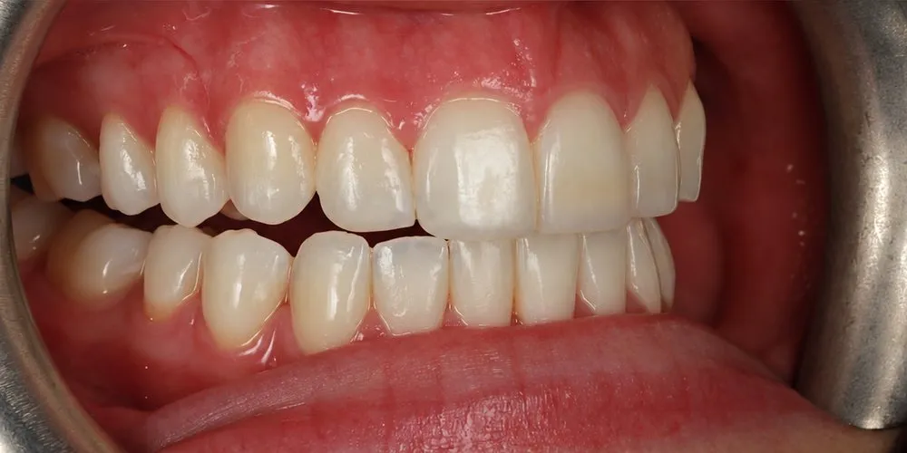 After: Relapse after braces: Invisalign, then four upper edges bonded