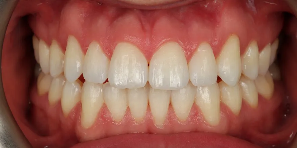 After: Invisalign for an open bite, prominent canines and crowding