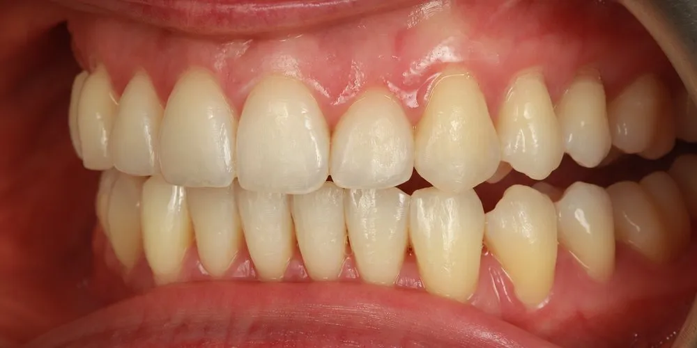 After: Invisalign for protruding, crowded teeth and a twisted front tooth