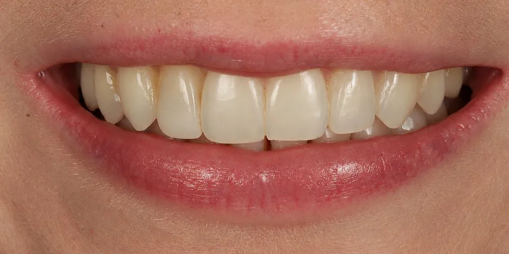 After: Invisalign for a Class II division 2 bite, plus one peg-shaped tooth
