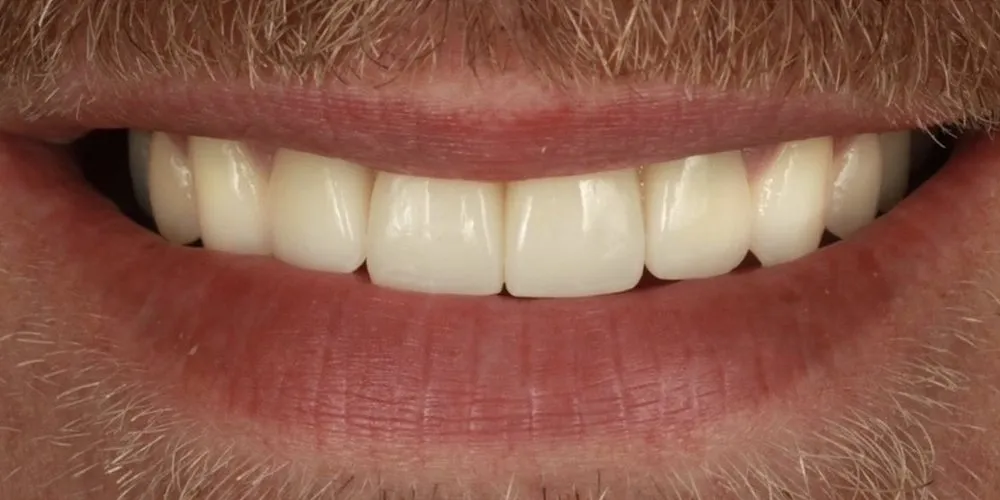 After: Straightened first, then implants and veneers added