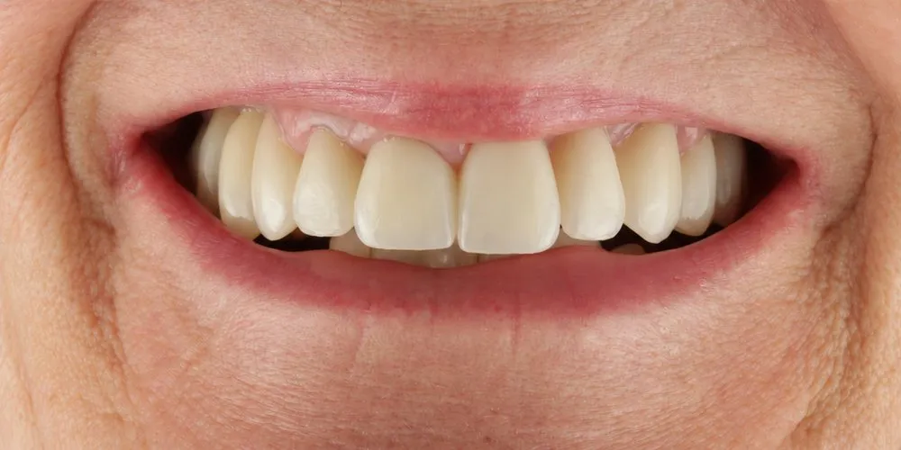 After: Failing restorations redone: new crowns, bridges and veneers