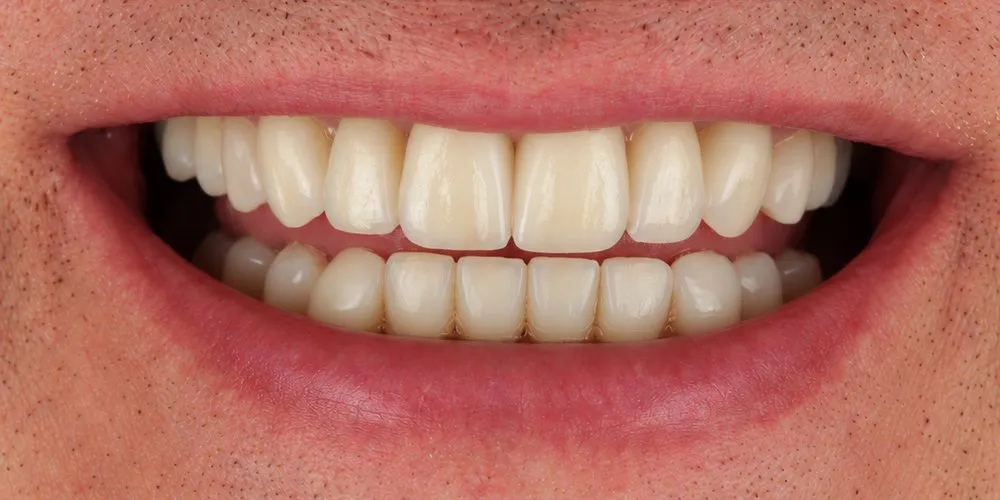 After: A makeover with veneers alone
