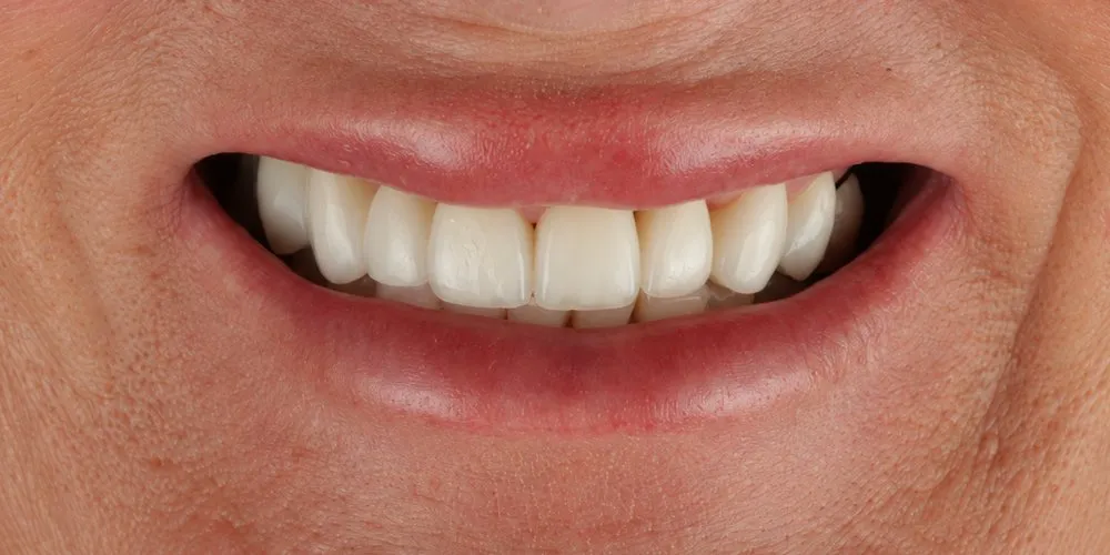 After: Tired old restorations renewed and gaps filled, using crowns, bridges and veneers